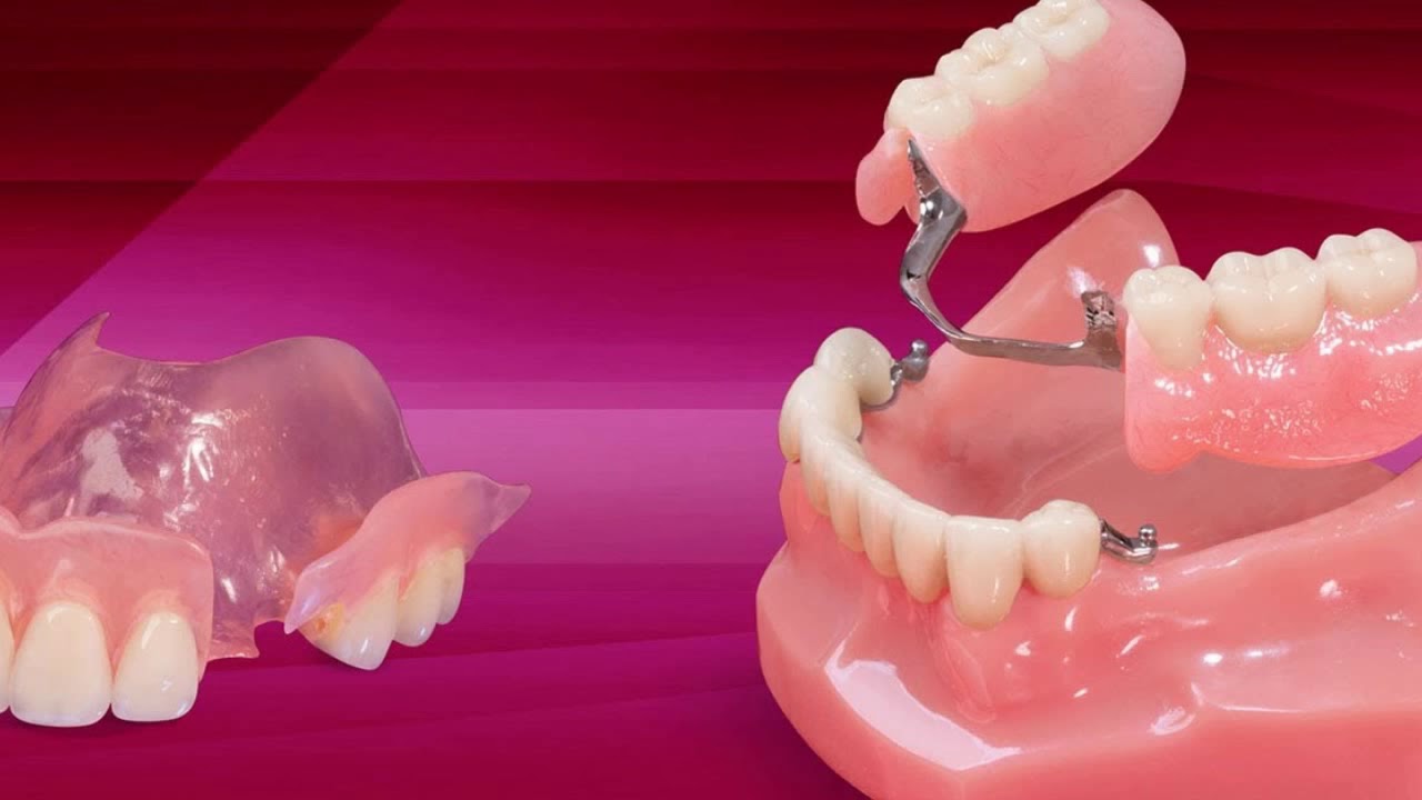 Как хранить съемные зубные протезы: 4 рекомендации от стоматологов