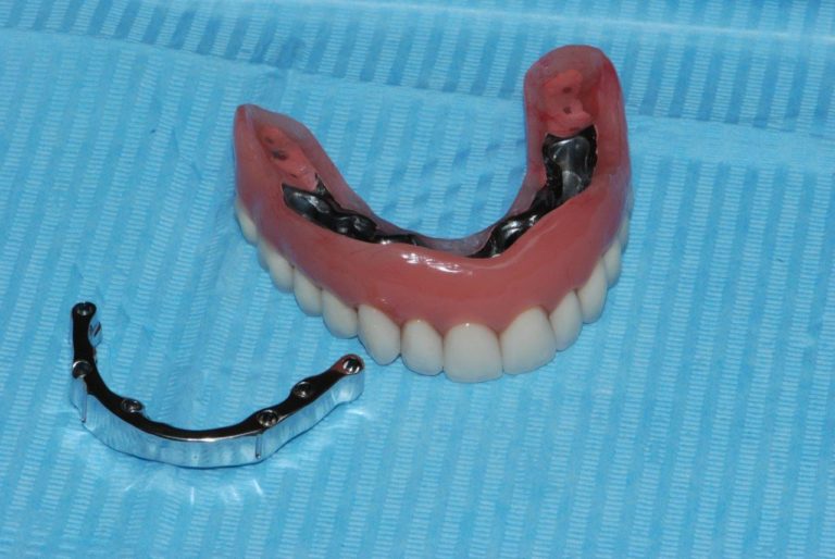 Съемные зубные протезы - какие лучше ставить при отсутствии зубов
